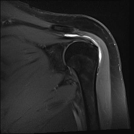 Subdeltoid Bursitis MRI