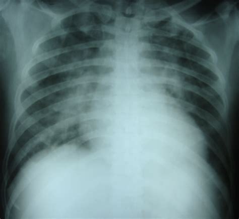 Chest X-ray supine view with pulmonary congestion – All About ...