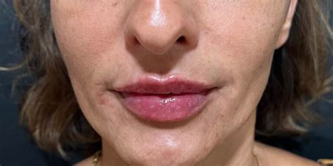 Lip Filler - Charlotte Medical Aesthetics