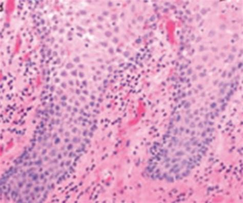 Median Rhomboid Glossitis Histology