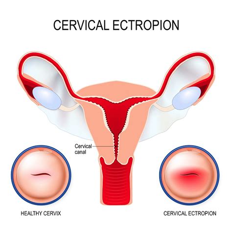 What Is a Cervical Ectropion? - Women's Health and Menopause Center | OB/GYN West Bloomfield, MI