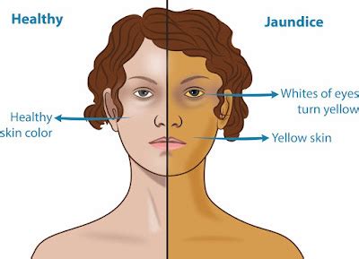 Yellow Skin (Jaundice): Pictures, Symptoms, Causes, and Diagnosis