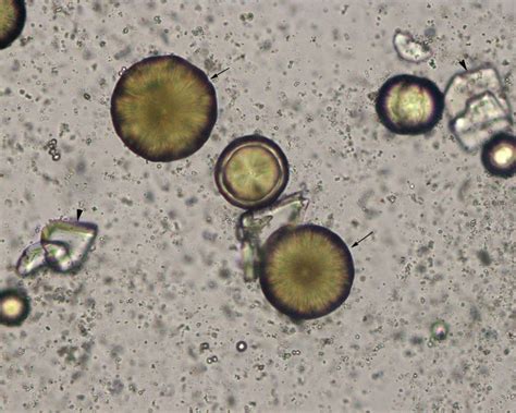 Urine crystals | eClinpath | Medical laboratory science, Urinal ...