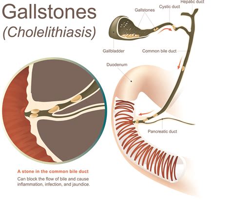 Symptoms of a Gallbladder Attack - Elite Hospital Kingwood