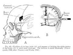 Lobotomy Procedure Steps