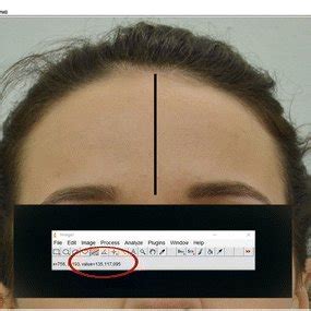 Measurement of the trichion to the glabella using Image J 1.47 version ...