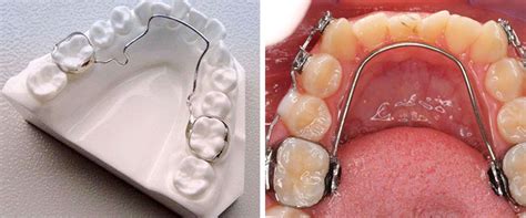 Orthodontics Space Maintainers