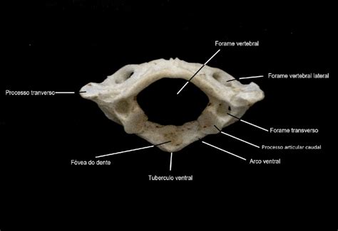 Primera vértebra cervical, atlas (aspecto caudal). | Download ...