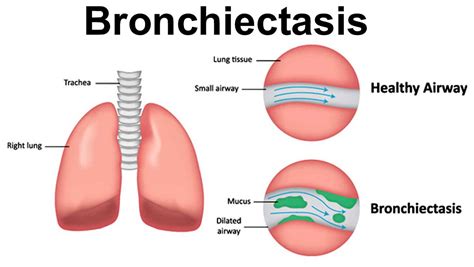 Bronchiectasis causes, signs, symptoms, diagnosis, prognosis & treatment