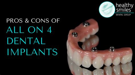 Pros and Cons of All-on-4 Dental Implants | Healthy Smiles Dental Group