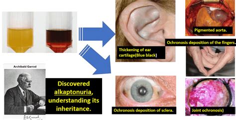 Whenever Child Passes Urine, It Turns Black: Spot the Diagnosis - CME INDIA