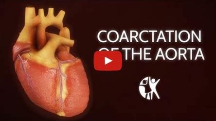 Coarctation Of The Aorta - Animation, Signs And Symptoms...