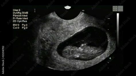 Ultrasound Video of an In Utero Baby Girl Stock ビデオ | Adobe Stock