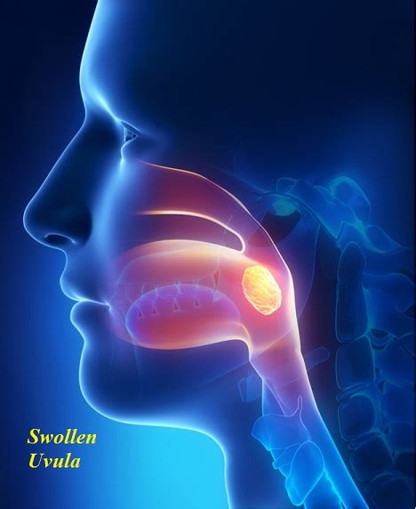 Swollen Uvula - Causes, Symptoms, Pictures, Treatment and Prevention - Drugs Details