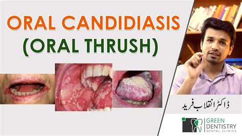 ORAL CANDIDIASIS | ORAL THRUSH | Causes | Prevention | Home Remedies | Urdu | @InqalabFareed ...