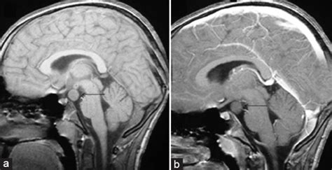 Hypothalamic hamartoma in a male child with central precocious puberty ...