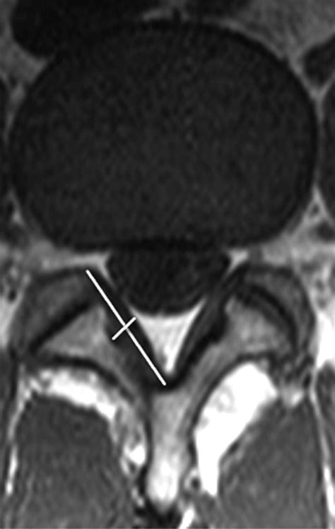 Ligamentum Flavum Hypertrophy Mri