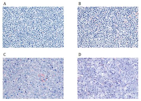 Diagnosis and treatment of mantle cell lymphoma