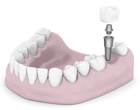 Dental-Implant-in-bottom-teeth - Dailley Dental Care | Halitosis ...