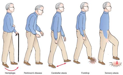 Gait Apraxia; Apraxia of Gait; Bruns' Apraxia of Gait; Dyspraxia of Gait