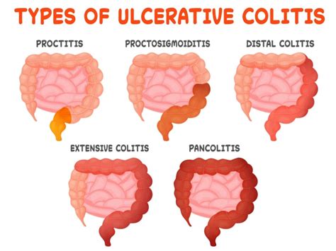 What is Ulcerative Colitis? | The IBS & Gut Health Clinic