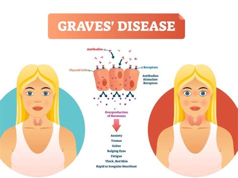 Graves' Disease- Symptoms, Treatments, & Causes