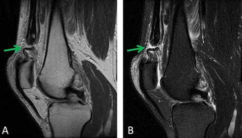 Ruptured Quadriceps Tendon