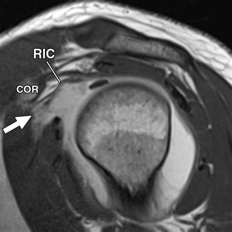 The Rotator Interval: A Review of Anatomy, Function, and Normal and Abnormal MRI Appearance | AJR