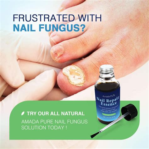 Toenail Fungus Treatment, Nail Fungus Treatment, Fungus Stop ...