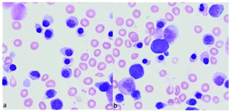 Representative bone marrow smears from a patient with beta-thalassemia ...