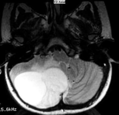 Juvenile Pilocytic Astrocytoma Imaging: Practice Essentials, Computed ...