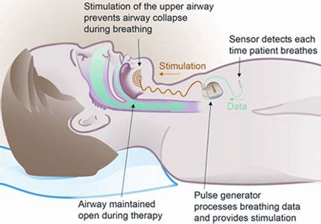 Nerve stimulation for sleep apnea | Nerve stimulator, Sleep apnea ...