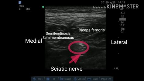 Ultrasound guided sciatic nerve block in the midthigh region - YouTube