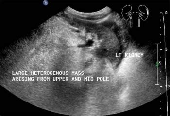 Ultrasound of left renal lesion | Download Scientific Diagram