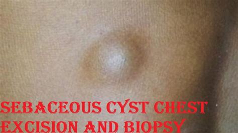 Pilar Cyst On Chest