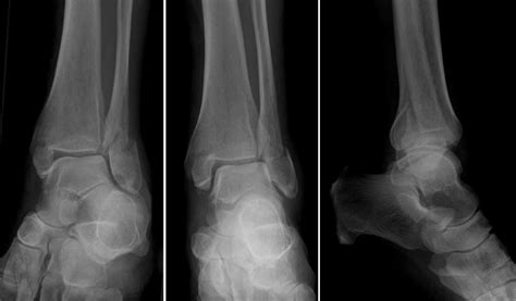 emorthoreview: Trimalleolar fracture A... - HCSM News