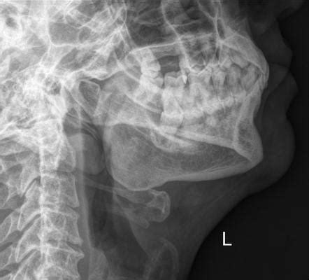 Mandible (axiolateral oblique view) | Radiology Reference Article | Radiopaedia.org