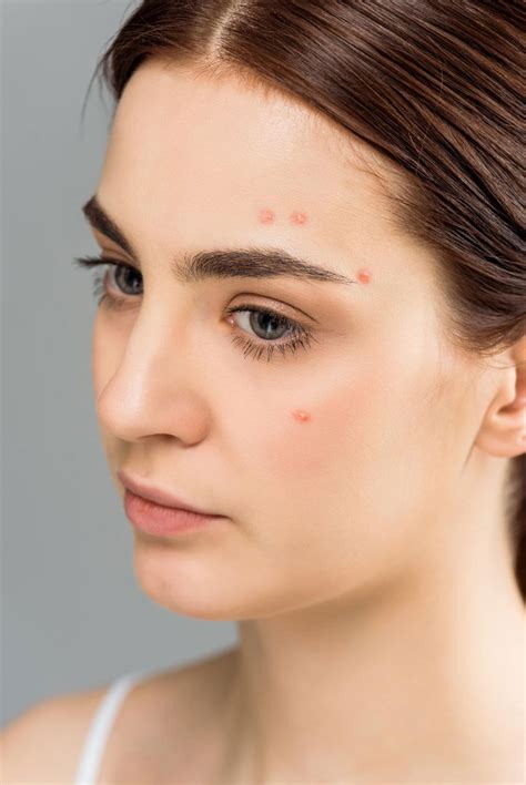 Acne – Solano Dermatology Associates