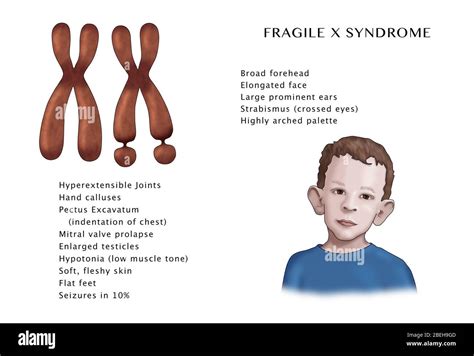 Fragile X Syndrome Karyotype