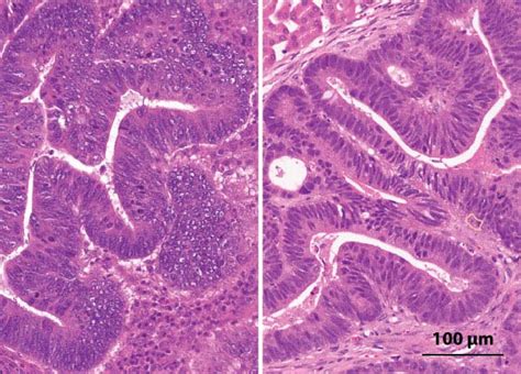 Building a colorectal cancer library - Keio Research Highlights