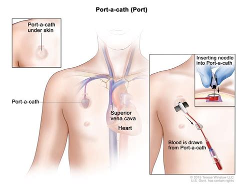 ER Nursing Skills: How to Access a Port-A-Cath, Video by Project Heartbeat President, Josh Burke ...