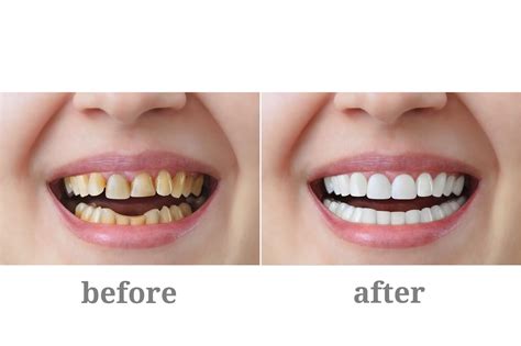 Porcelain Crowns & Porcelain Bonded Crowns - Treatment, Care & Advice