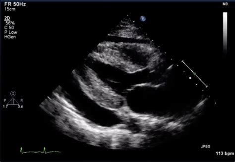 Ultrasound Ninja: Consider the Probe 3: So I've found the effusion, now ...