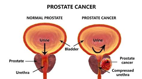 Prostate Cancer - Definisi, Penyebab, Gejala, dan Tata Laksana | AI Care