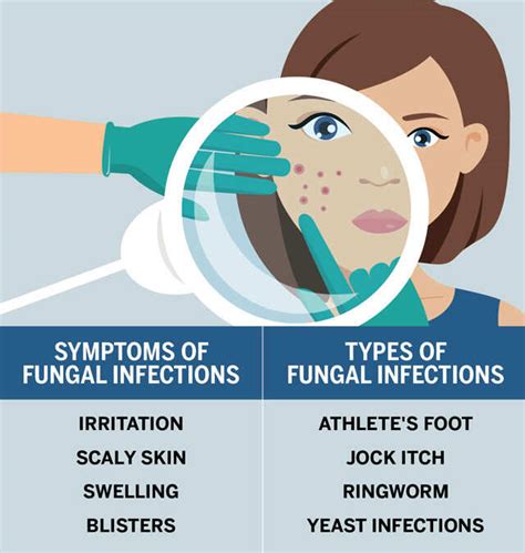 Fungal Rash On The Face: Causes, Treatment, And Prevention, 44% OFF