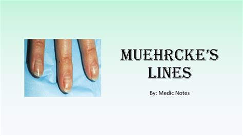 Muehrcke's lines causes and pathophysiology - YouTube