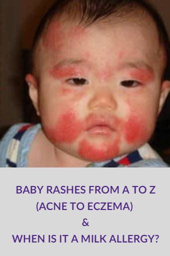 Baby Rashes from A to Z (Acne to Eczema!) and When Is It a Milk Allergy? | Neocate