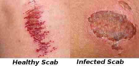 Infected Scab?, How You Can Tell and What To Do About it | Infections ...