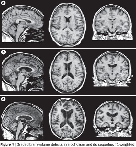 Figure 2 from Clinical and pathological features of alcohol-related ...