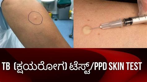 TB SKIN TEST.PPD /MANTOUX TEST COST ,POSITIVE/NEGETIVE RESULT, ADVERSE ...